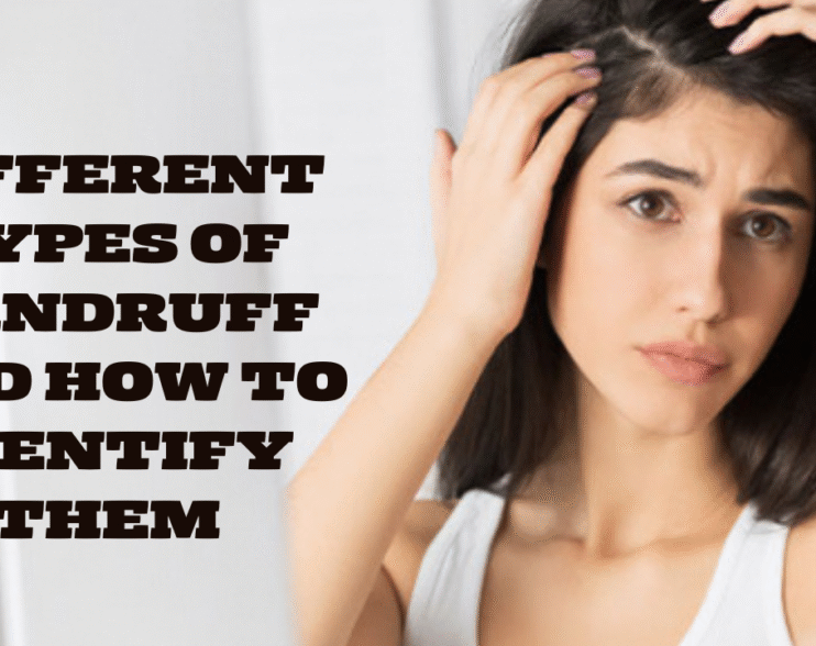 Different Types of Dandruff and How to Identify Them
