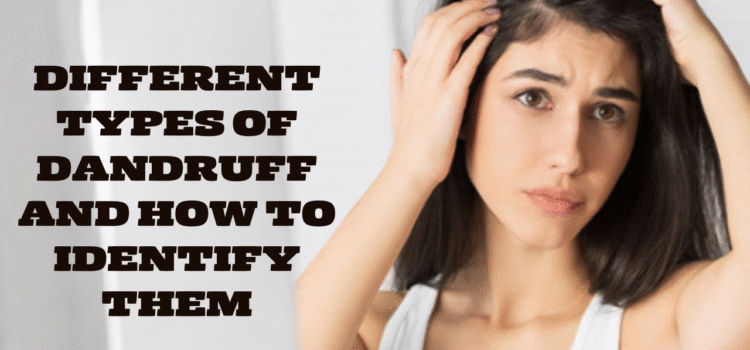 Different Types of Dandruff and How to Identify Them