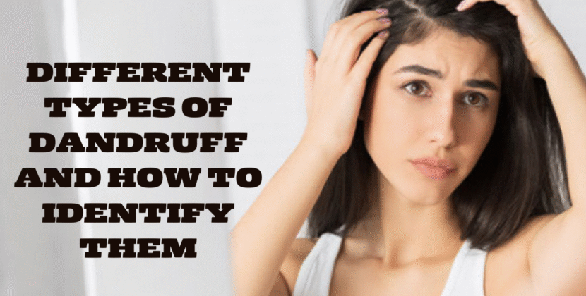 Different Types of Dandruff and How to Identify Them
