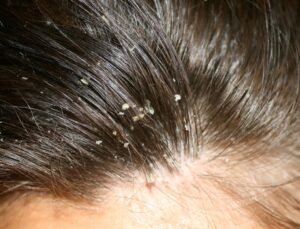 Fungal Dandruff