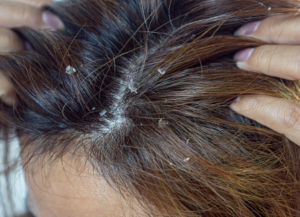  Oily Scalp Dandruff
