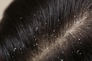 Product Buildup Dandruff