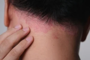 Psoriasis-Related Dandruff